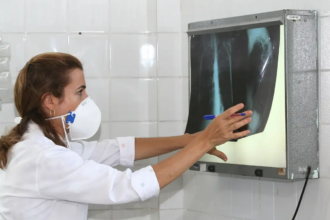Tuberculose: Amazonas lidera incidência no Brasil, seguido por Roraima e Rio de Janeiro
