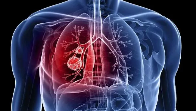 Ceap-Sol alerta para importância do diagnóstico precoce no combate à tuberculose